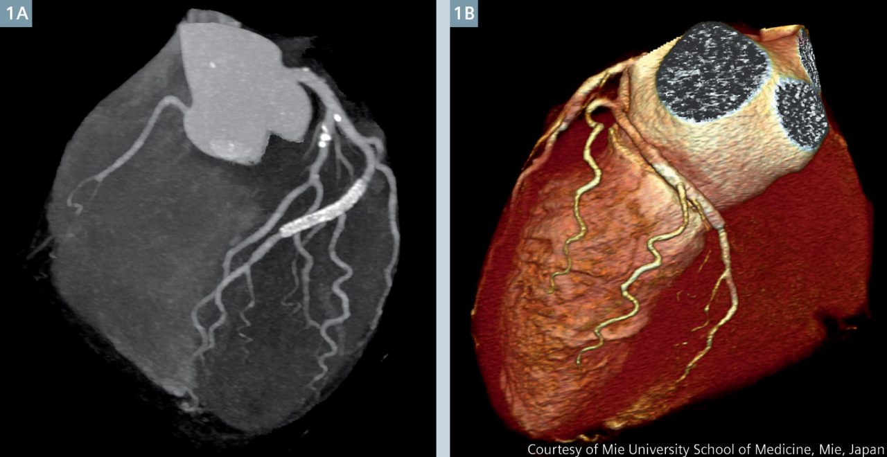 CORONARY CT ANGIOGRAPHY AND 5 YEAR RISK OF MYOCARDIAL INFARCTION 